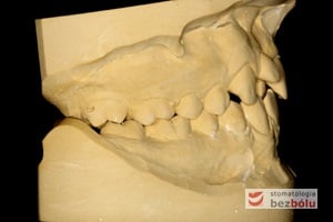 modele gipsowe przed leczeniem