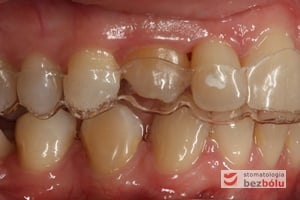 Strona prawa - zęby w zwarciu z założonym pozycjonerem Strona prawa - zęby w zwarciu z założonym pozycjonerem