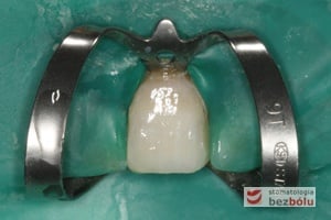 Odbudowany ząb kompozytem w osłonie koferdamu utrzymywanym klamrą motylkową Odbudowany ząb kompozytem w osłonie koferdamu utrzymywanym klamrą motylkową - rekonstrukcja na Fibre Core