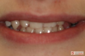 Uśmiech pacjentki przed leczeniem Uśmiech pacjentki przed leczeniem