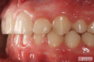 Widok warunków zgryzowych po leczeniu - strona lewa Widok warunków zgryzowych po leczeniu - strona lewa