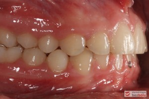 Widok warunków zgryzowych po leczeniu - strona prawa Widok warunków zgryzowych po leczeniu - strona prawa