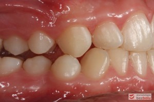 Warunki zgryzowe przed leczeniem - strona prawa Warunki zgryzowe przed leczeniem - strona prawa