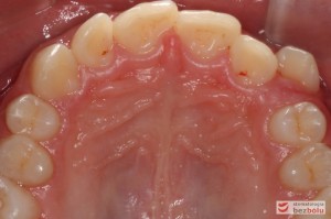 Widok łuku górnego przed leczeniem Widok łuku górnego przed leczeniem