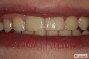 Uśmiech pacjentki po leczeniu Uśmiech pacjentki po leczeniu