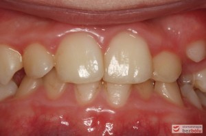 Warunki zgryzowe przed leczeniem od frontu Warunki zgryzowe przed leczeniem od frontu