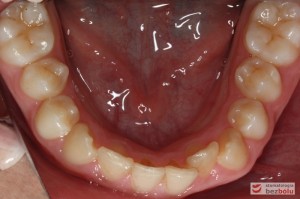 Widok łuku dolnego przed leczeniem Widok łuku dolnego przed leczeniem