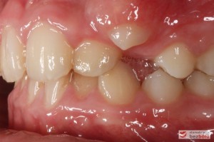 Warunki zgryzowe przed leczeniem - strona lewa Warunki zgryzowe przed leczeniem - strona lewa