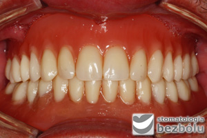 Od bezzębia do radosnego uśmiechu