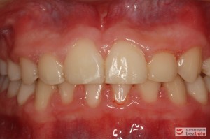 Widok warunków zgryzowych od frontu uzyskanych po leczeniu Widok warunków zgryzowych od frontu uzyskanych po leczeniu