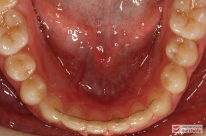 Widok łuku dolnego po leczeniu Widok łuku dolnego po leczeniu