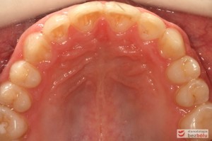 Widok łuku górnego po leczeniu Widok łuku górnego po leczeniu