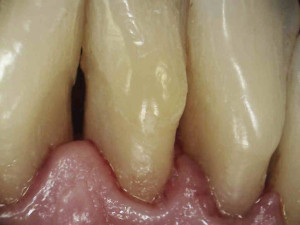 zdjęcie 5 - widok od strony język owej – kamera zewnątrzustna