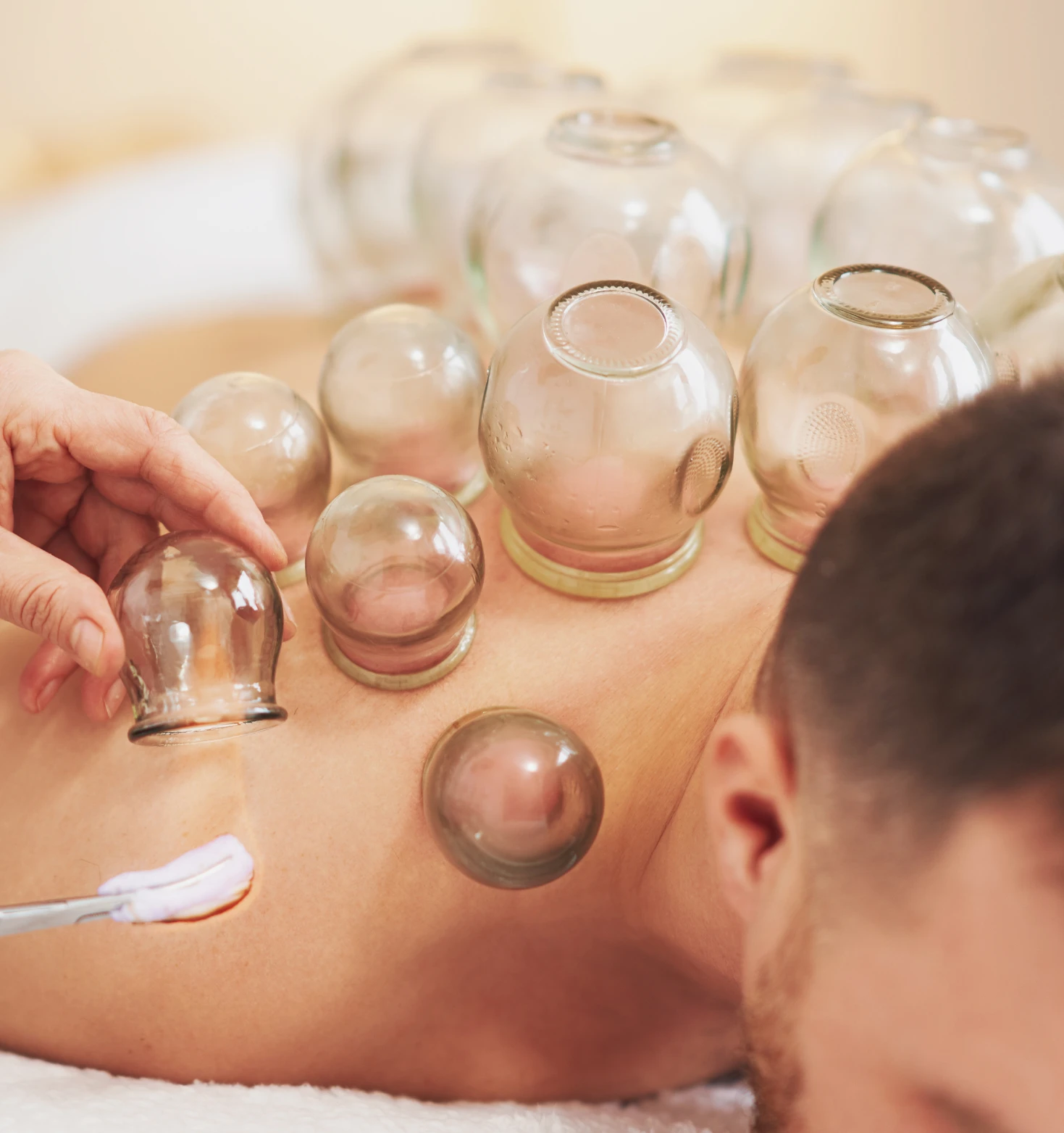 cupping therapy