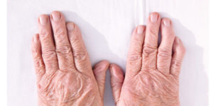 ארתריטיס ניוונית