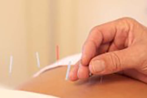 דיקור סיני לטיפול בכאב