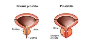 דיקור סיני לפרוסטטה