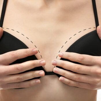 Young female body with marks for plastic operation, closeup