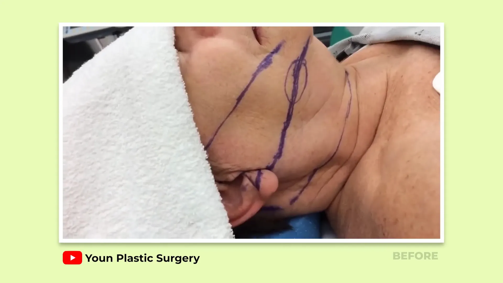 מתיחת פנים דיפ פלאן