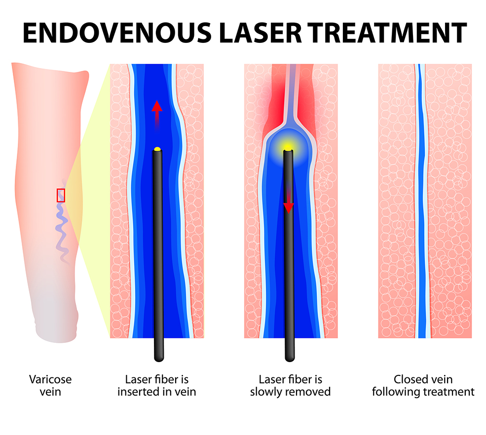 Laser endoveineux ou radiofréquence : quelle différence pour traiter les varices en 2025 ?