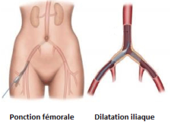 trait-endo2 Chirurgie vasculaire tunisie