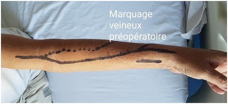 Fistule Artério-Veineuse