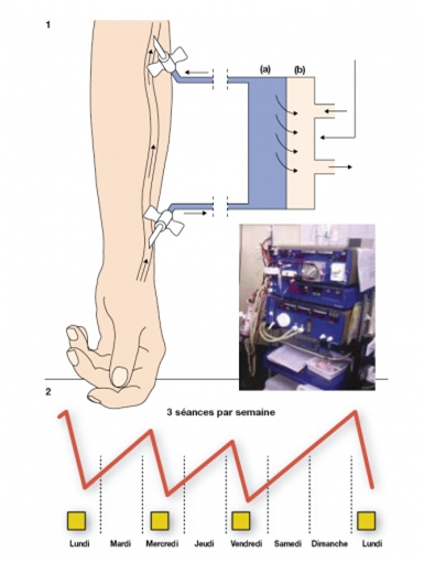Procédure d’Hémodialyse