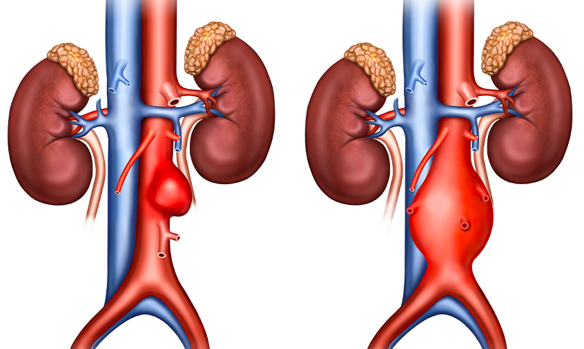 Quelles sont les causes d’un anévrisme de l’aorte abdominale ?