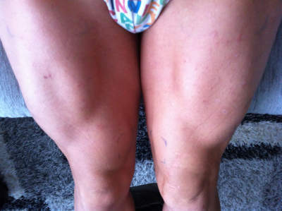 atrofia cuádriceps recuperación con electroestimulacion hipertrofia muscular con electroestimulacion mes 2. elimina la atrofia muscular