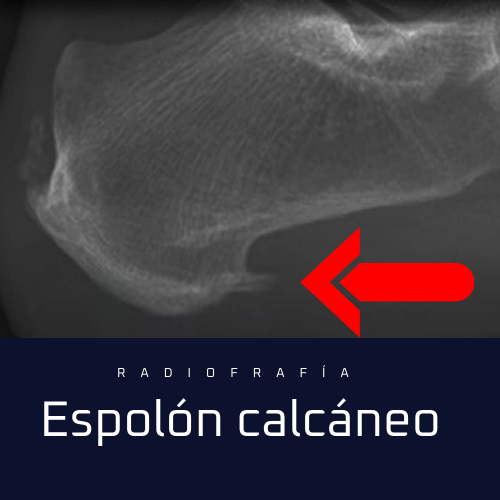 Radiografía de un espolón en el hueso calcáneo Espolón calcáneo en el talón. Tratamiento espolón calcáneo con microcorriente