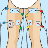 bíceps femoral electroestimulacion colocación parches tratamiento cintilla iliotibial colocacion electrodos
