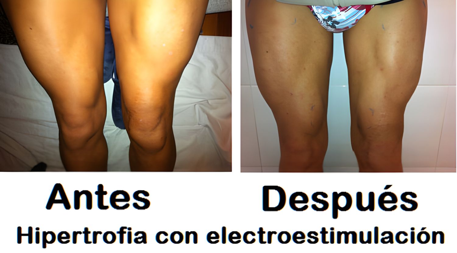 Músculos atrofiados, atrofia muscular piernas y electroestimulación antes y después