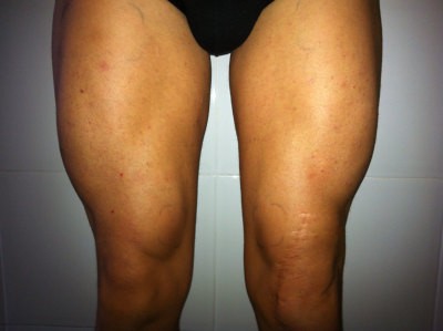 Hipertrofia muscular con electroestimulacion mes 3. Elimina la atrofia muscular