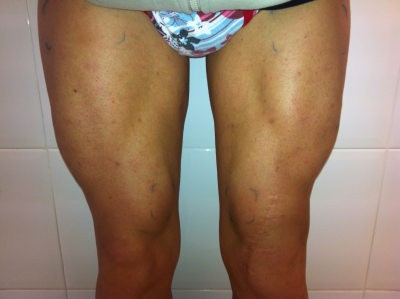 musculo atrofiado tratamiento electroterapia hipertrofia muscular mes 4. elimina la atrofia muscular piernas