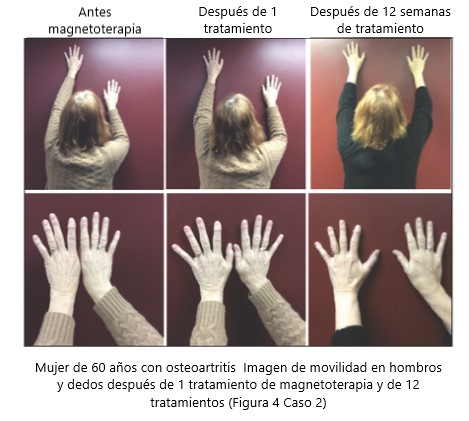 efercto de la magnetoterapia sobre la artritis artritis reumatoide tratamiento con magnetoterapia