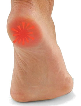 tratamiento espolón en el pie con microcorriente Espolón Calcáneo, tratamiento microrriente