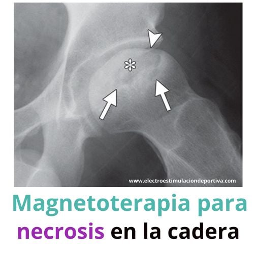 como curar la necrosis. Osteonecrosis tiene cura La necrosis de cadera tiene cura con magnetoterapia