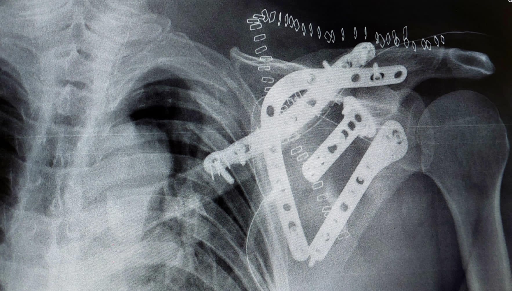 Magnetoterapia con material de osteosintesis. Contraindicaciones magnetoterapia.