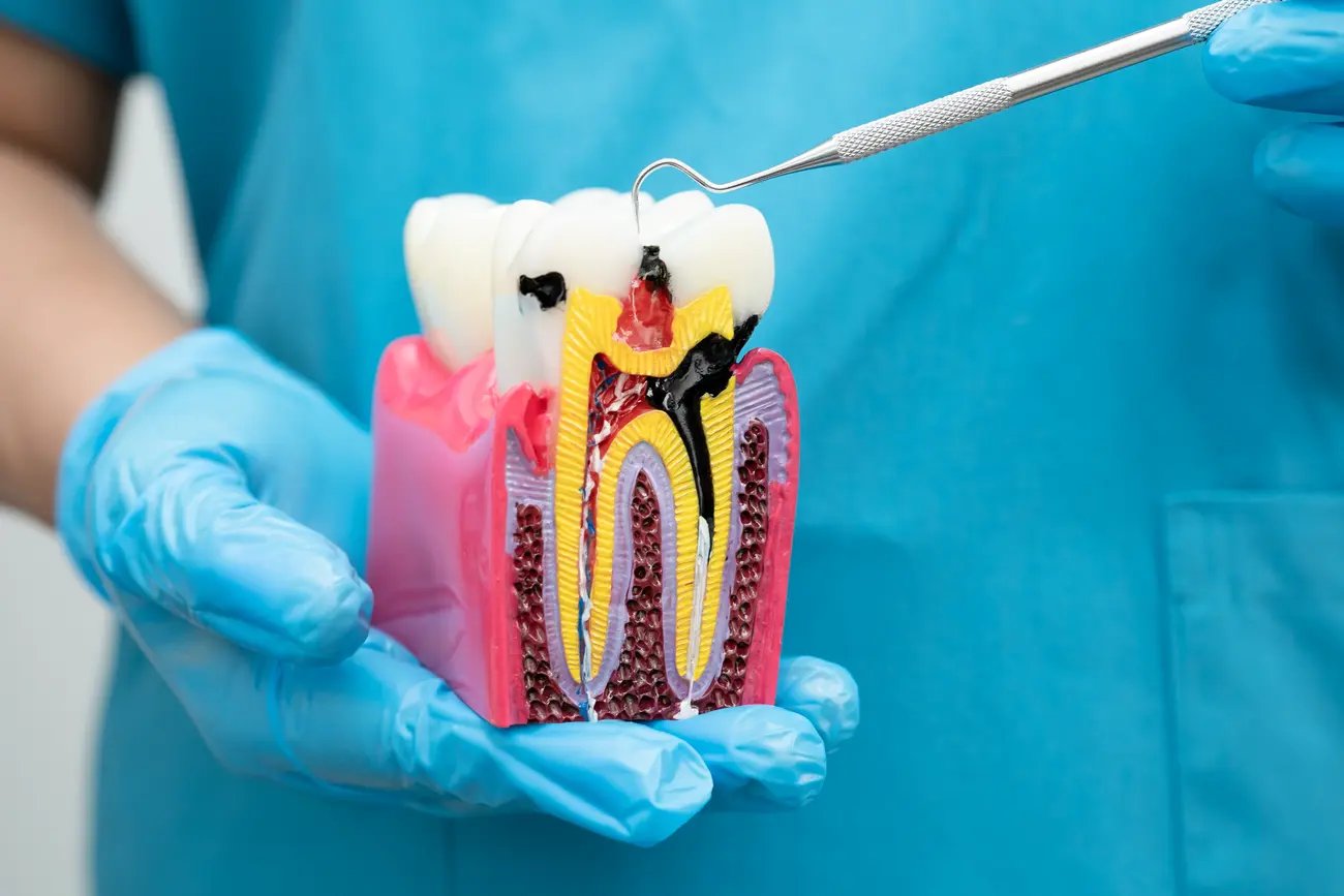 Kiedy leczenie kanałowe jest odpowiedzią na problemy z zębami?