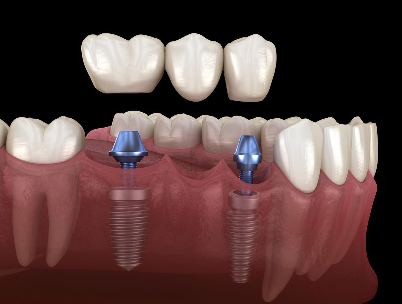 Most na dwóch implantach