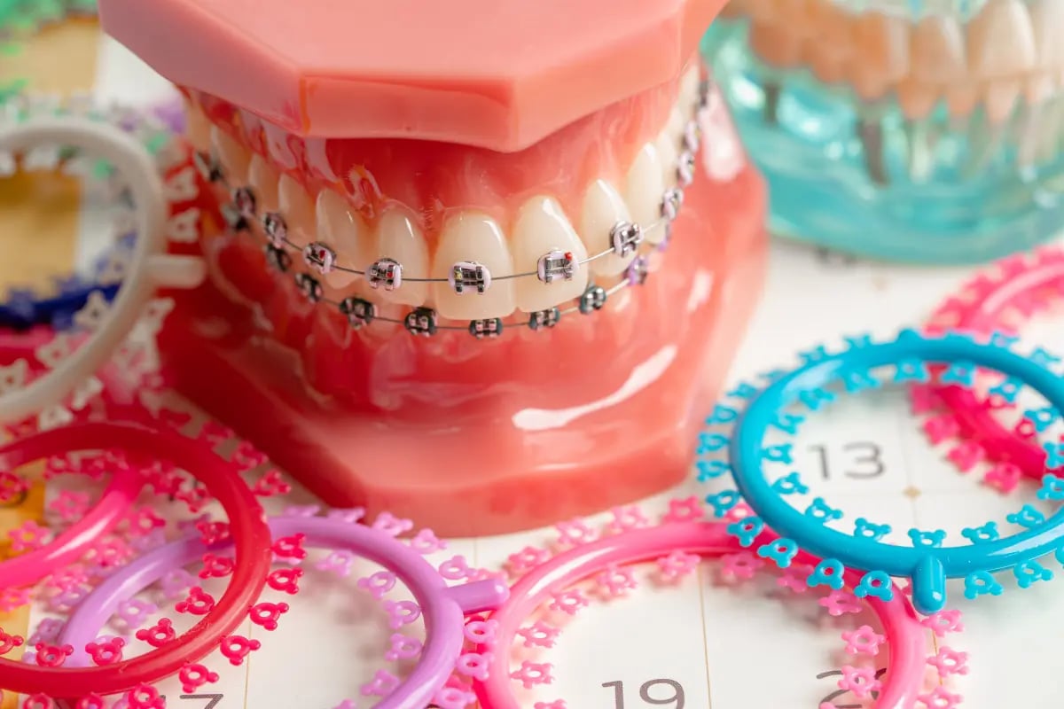 Ligatury ortodontyczne – czym są, jak działają, dostępne rodzaje