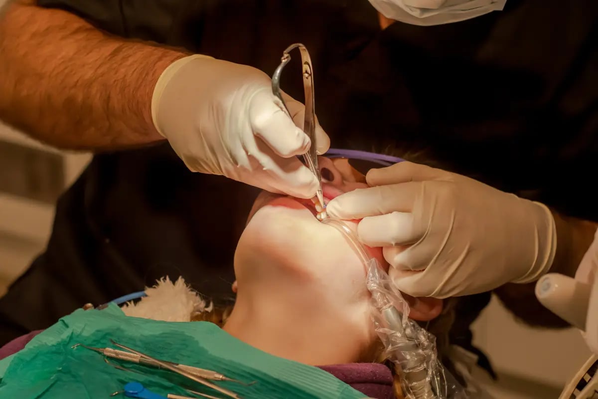 Usuwanie zębów u dzieci