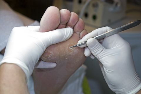Corns and Callosities