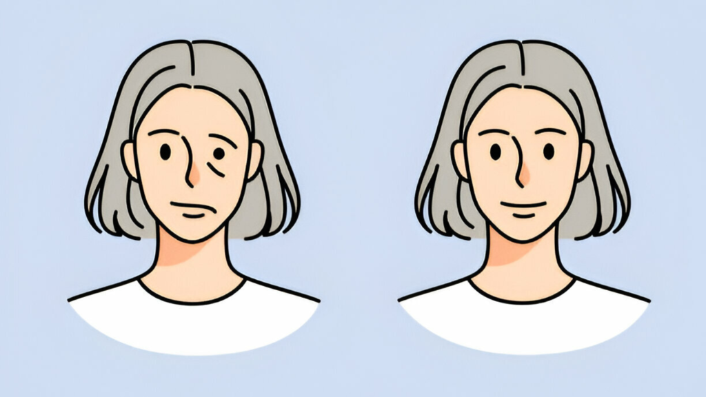 Acupuncture Treatment To cure Bell's Palsy (Facial Paralysis)