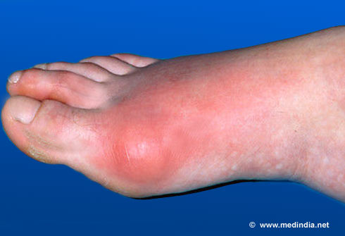 Homeopathic Medicines For Uric Acid