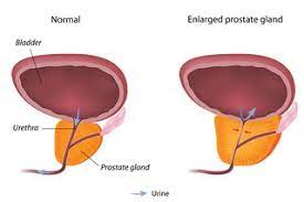 Benign prostatic hyperplasia