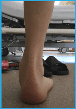 Plattfuß vor einer Plattfuß-Operation