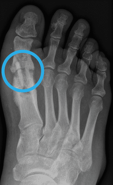 Pseudarthrose, Hallux rigidus, Fuß Operation, Arthrodese nicht verheilt
