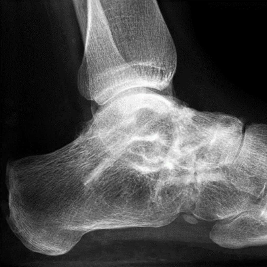 Triple-Arthrodese 12 Monate postoperativ img-4