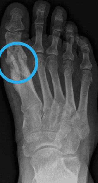 Pseudarthrose Heilung, Hallux rigidus, Leben mit Pseudarthrose Fuß Operation, Arthrodese nicht verheilt Pseudarthrose